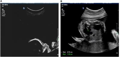 Prenatal Diagnosis of Recurrent Distal 1q21.1 Duplication in Three Fetuses With Ultrasound Anomalies